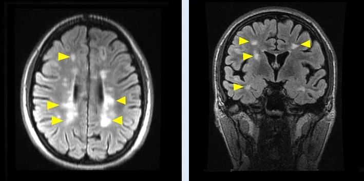 Σκλήρυνση κατά πλάκας: Νέα πειραματική θεραπεία από Ομογενή